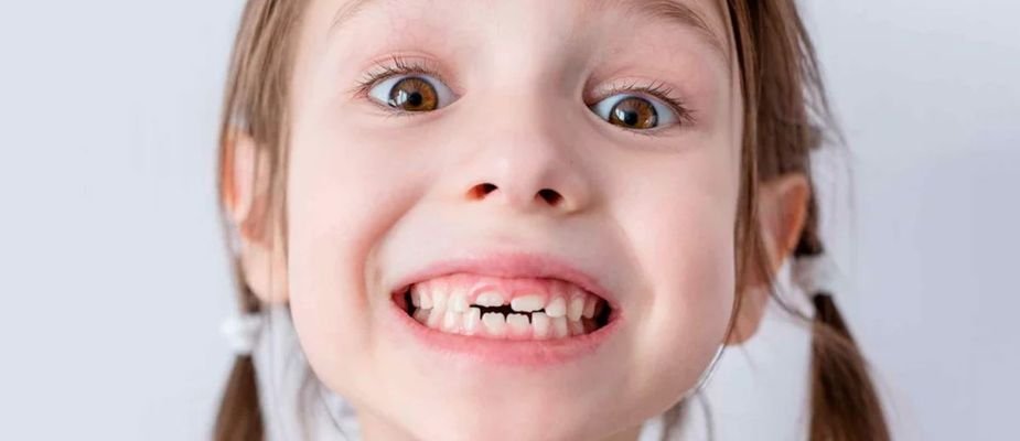 Dente de Leite: Quando Cai e Como Cuidar